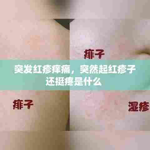 突发红疹痒痛,突然起红疹子还挺疼是什么