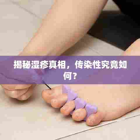 揭秘湿疹真相，传染性究竟如何？