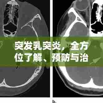 突发乳突炎,全方位了解、预防与治疗策略